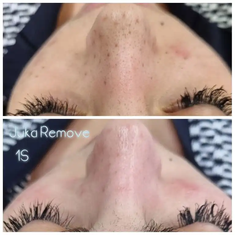 carbon_peel_nez_avant_apres